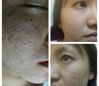 ĐIỀU TRỊ SẸO RỖ LẦN ĐẦU TIÊN