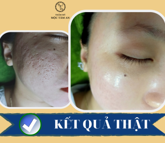 TRƯỚC VÀ SAU KHI ĐIỀU TRỊ RỖ BẰNG BICO
